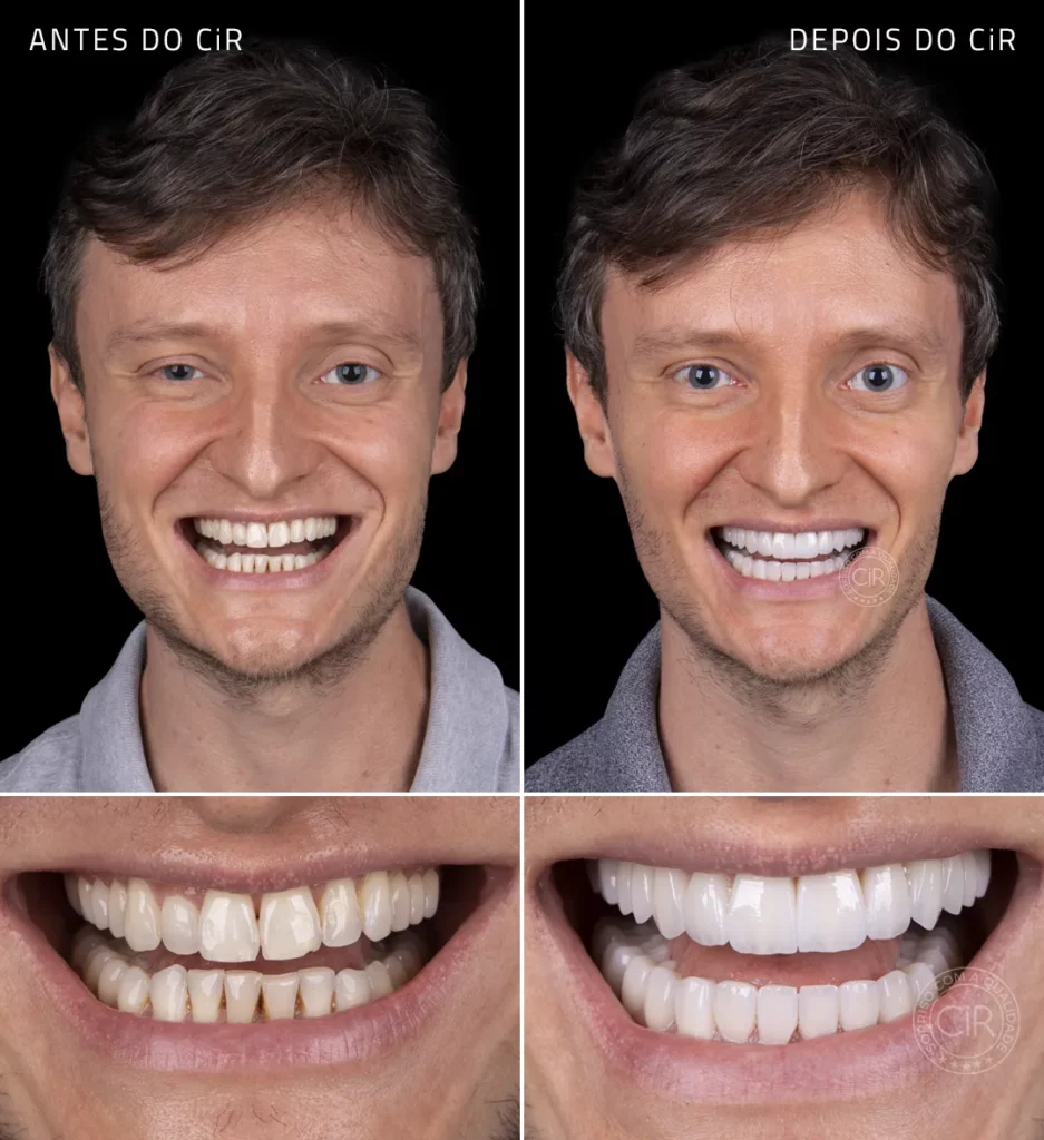 antes e depois da reabilitação oral com as as lentes de contato dental do paciente de 37 anos no cir atendimento premium asa sul asa norte sudoeste octogonal