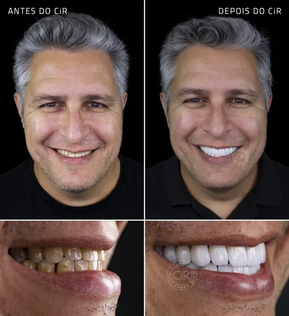 antes e depois da reabilitação oral com as facetas dentarias em todos os dentes do paciente de bruxismo