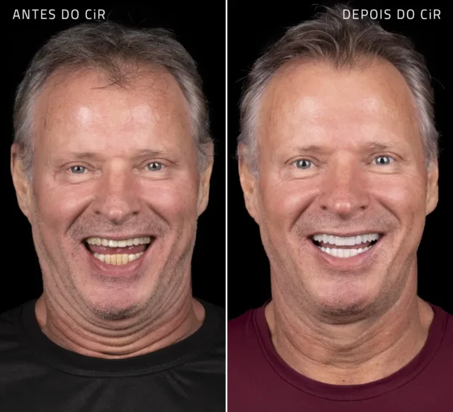 antes de depois das lentes em porcelana em todos os dentes do nosso paciente do rio de janeiro