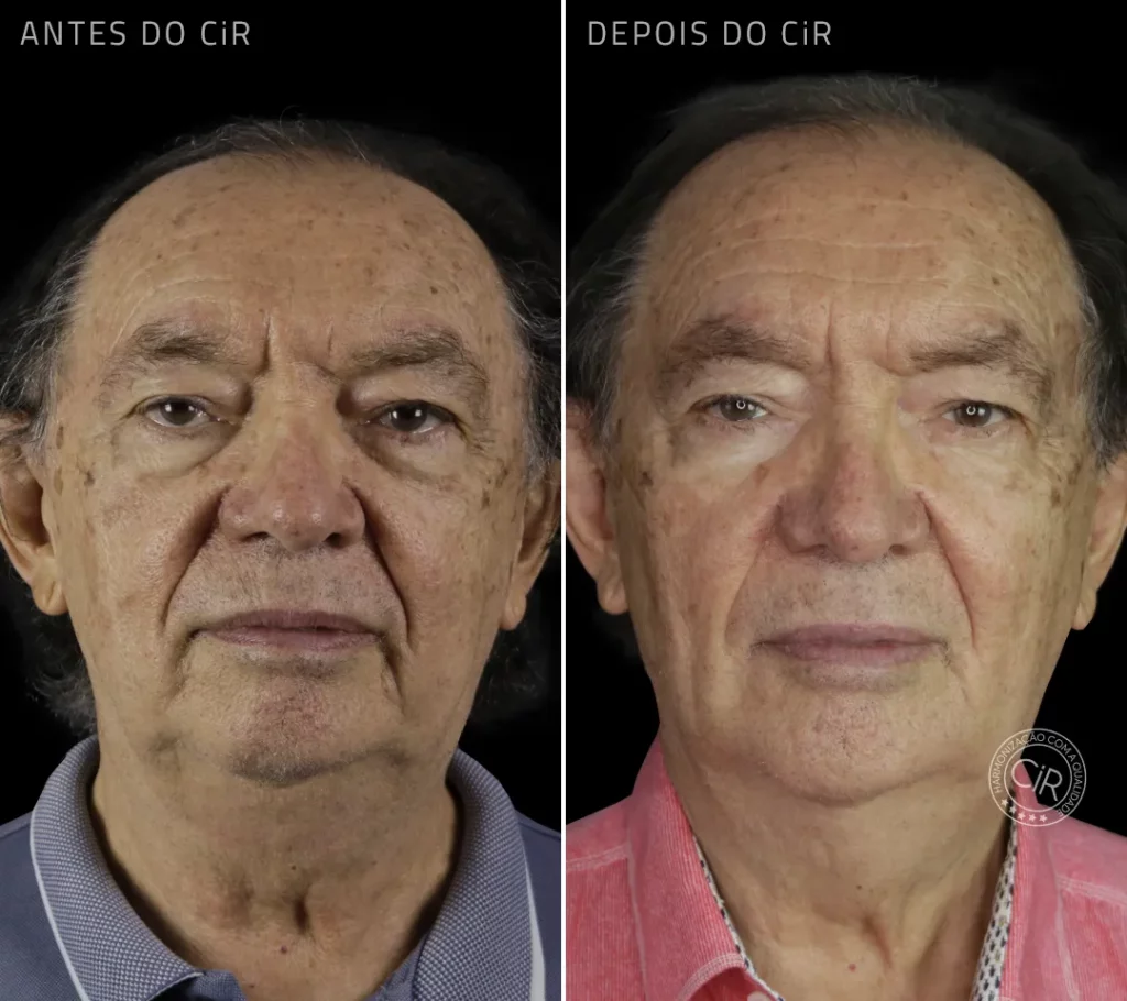 harmonização facial full face em paciente masculino de 73 anos aqui no cir hospital odontológico atendimento premium lago sul lago norte park way noroeste sudoeste