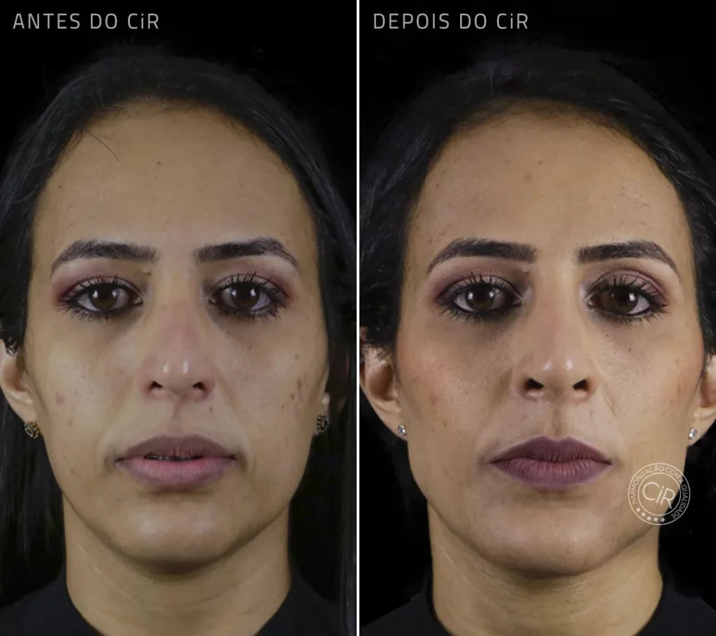 harmonização facial full face na paciente de 38 anos no cir hospital odontológico de brasília atendemos lago sul lago norte sudoeste octogonal