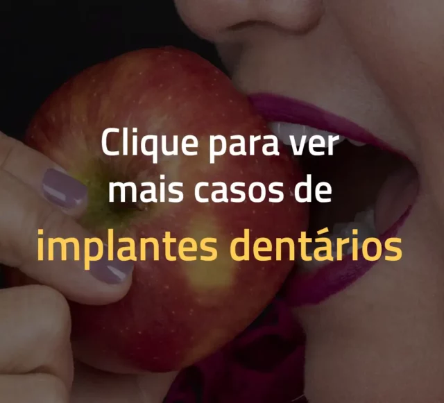 veja casos de antes e depois de implantes dentários no cir lago sul lago norte asa sul asa norte